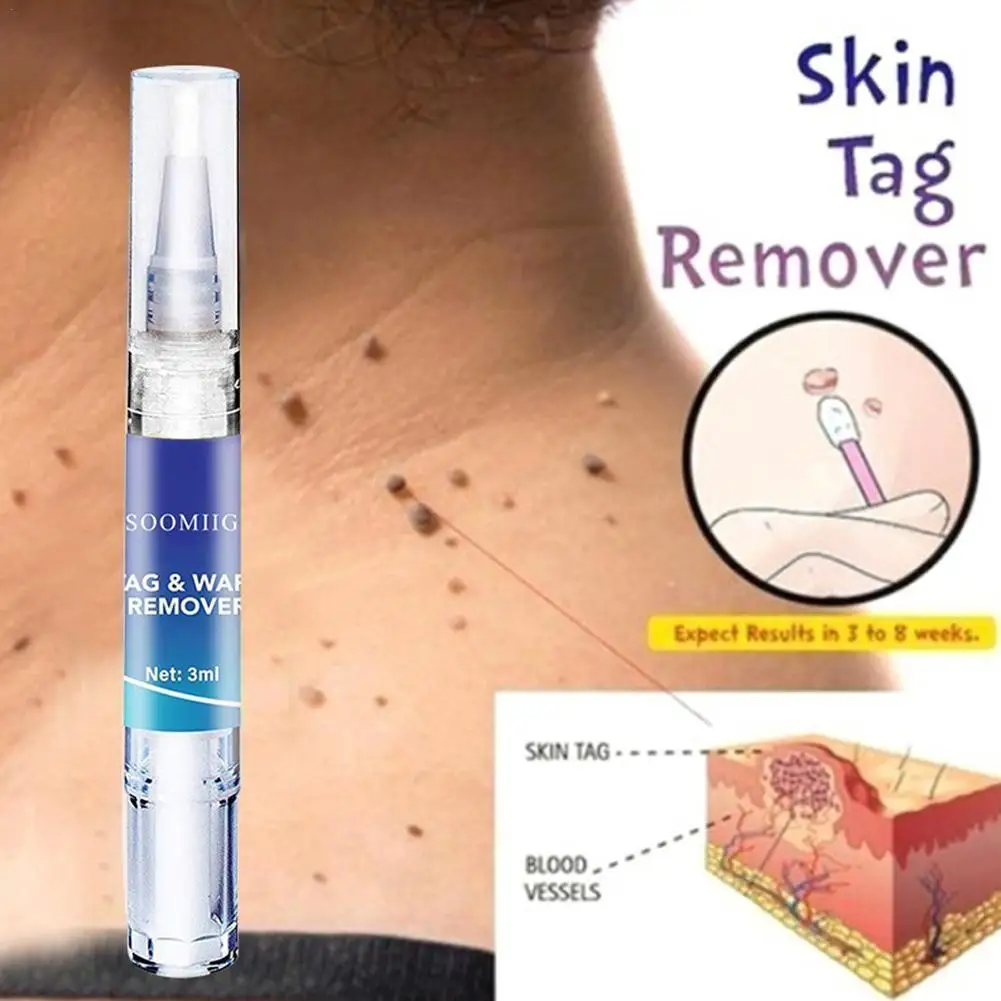 

3ml Skin Tag Genital Wart Remover Pen Herbal Extract Serum Mole Wart Skin Tag Foot Corn Warts Treatment Skin Tag Removal