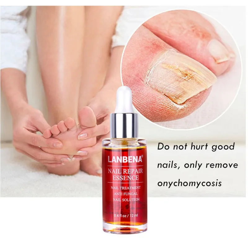 Натуральная антиинфекционная паронихия онихомикоз лечение грибковых ногтей