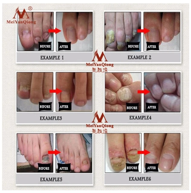 Средство для лечения грибка ногтей эссенция ухода за ногами отбеливающий гель