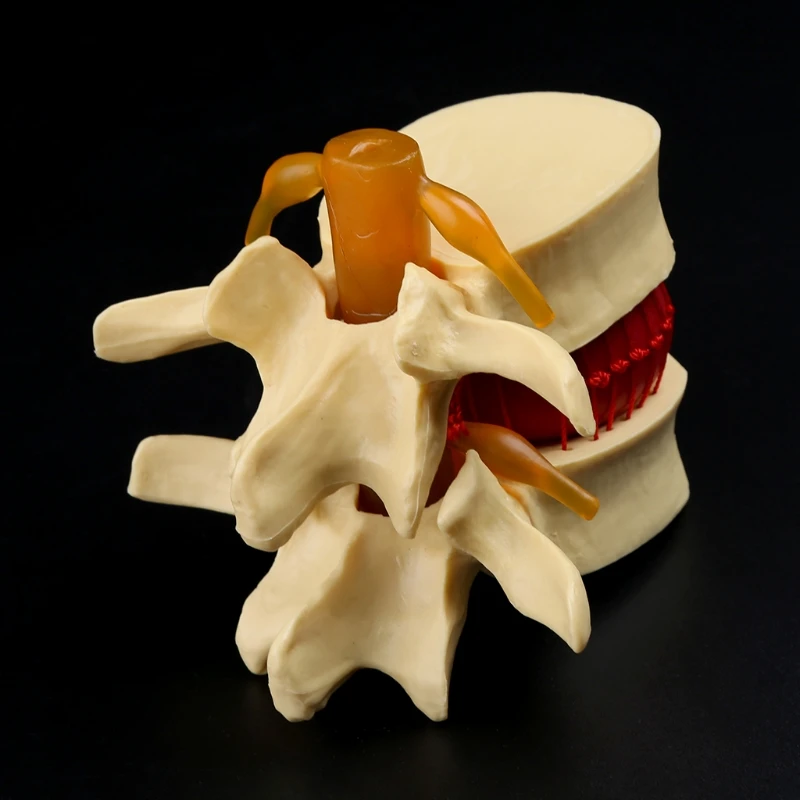 

Medical props model Free postage Anatomical Spine Lumbar Disc Herniation Anatomy Medical Teaching Tool