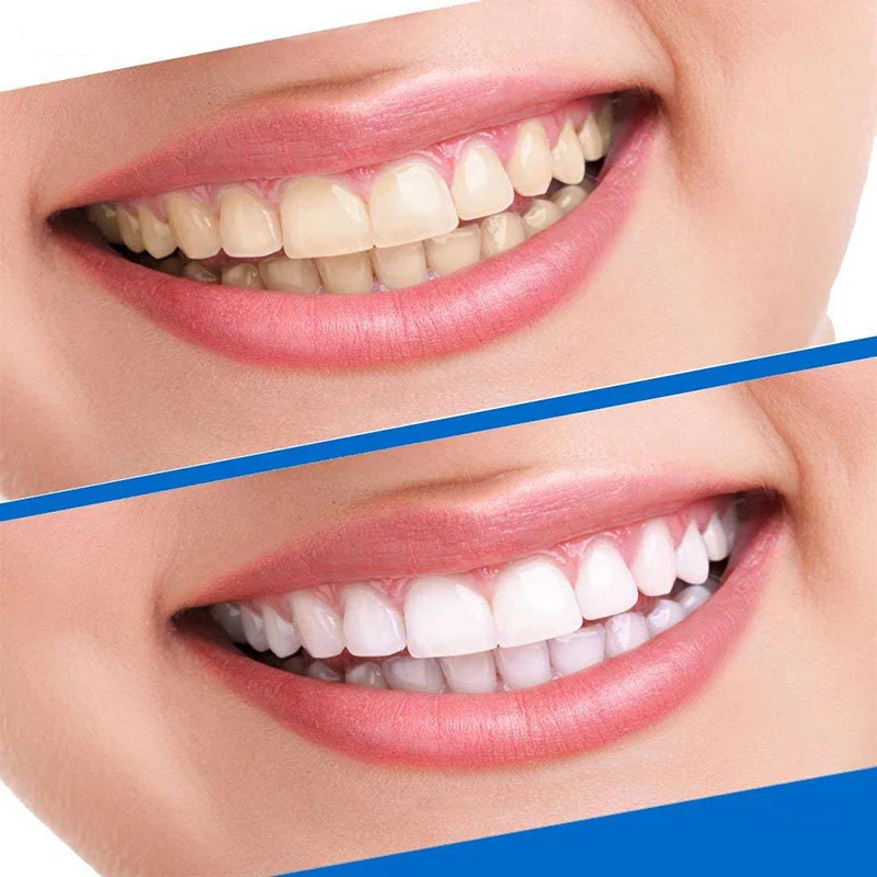 

Teeth Whitening Strips Oral Hygiene Care Kit Stain Removal for Oral Hygiene Clean Double Elastic Dental Bleaching Strip 28/14Pcs