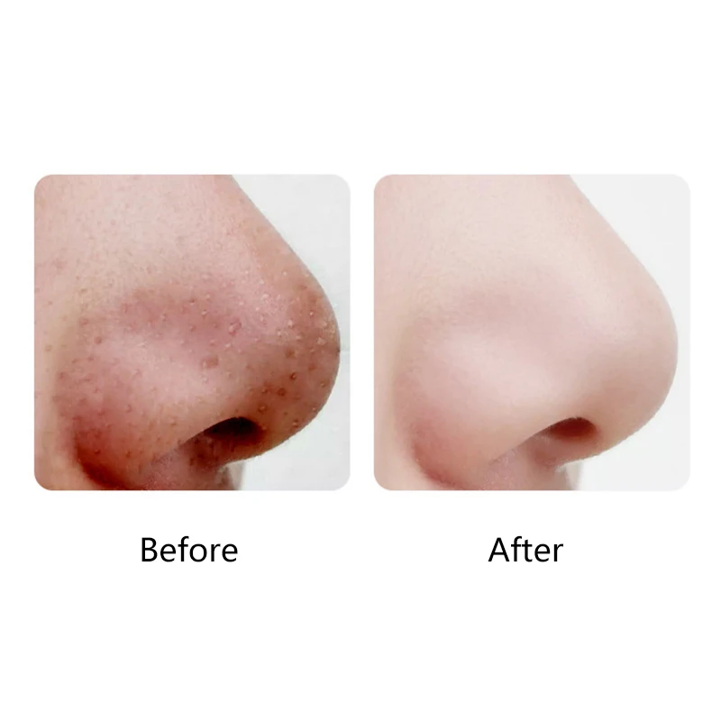 

Electric Blackhead Remover Vacuum Black Points Extractor Deep Pore Cleaner Acne Remover Skin Care Machine With 3 Mode Beauty