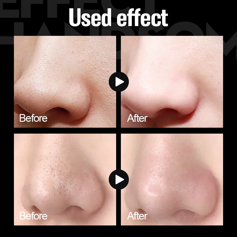 MANCODES Для мужчин новый вулканической грязи маска для удаления угрей комплект