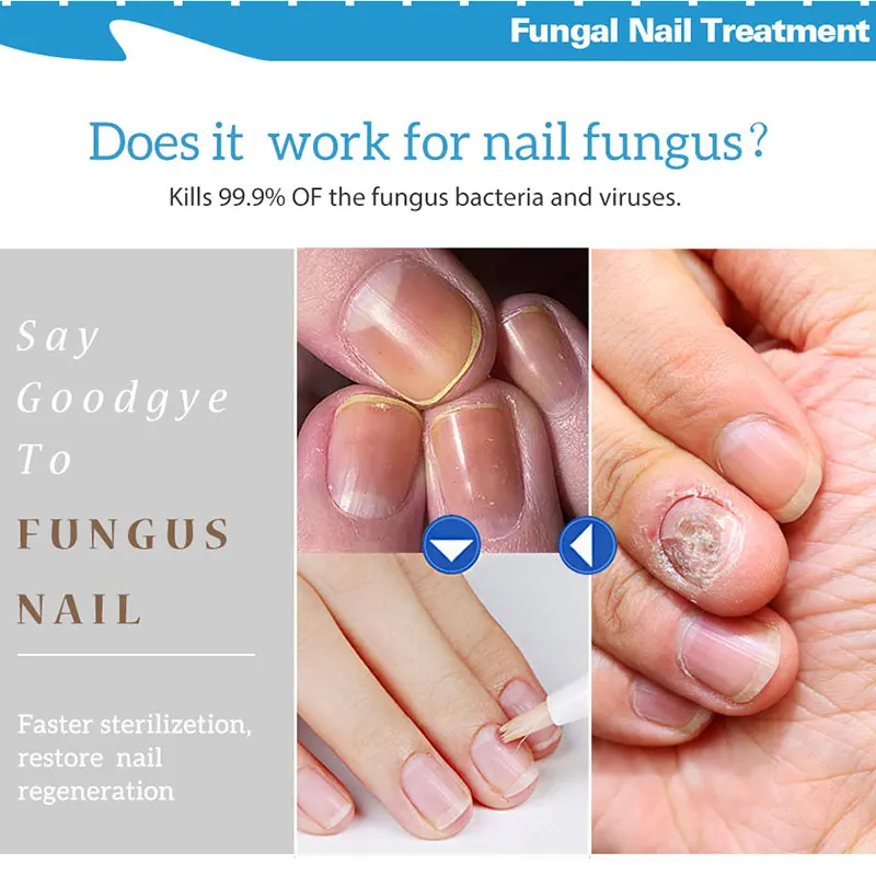 Powerful Nail Treatment Pen Onychomycosis Paronychia Anti Fungal Nail Infection Chinese Herbal Toe Fungus Care Repair Serum