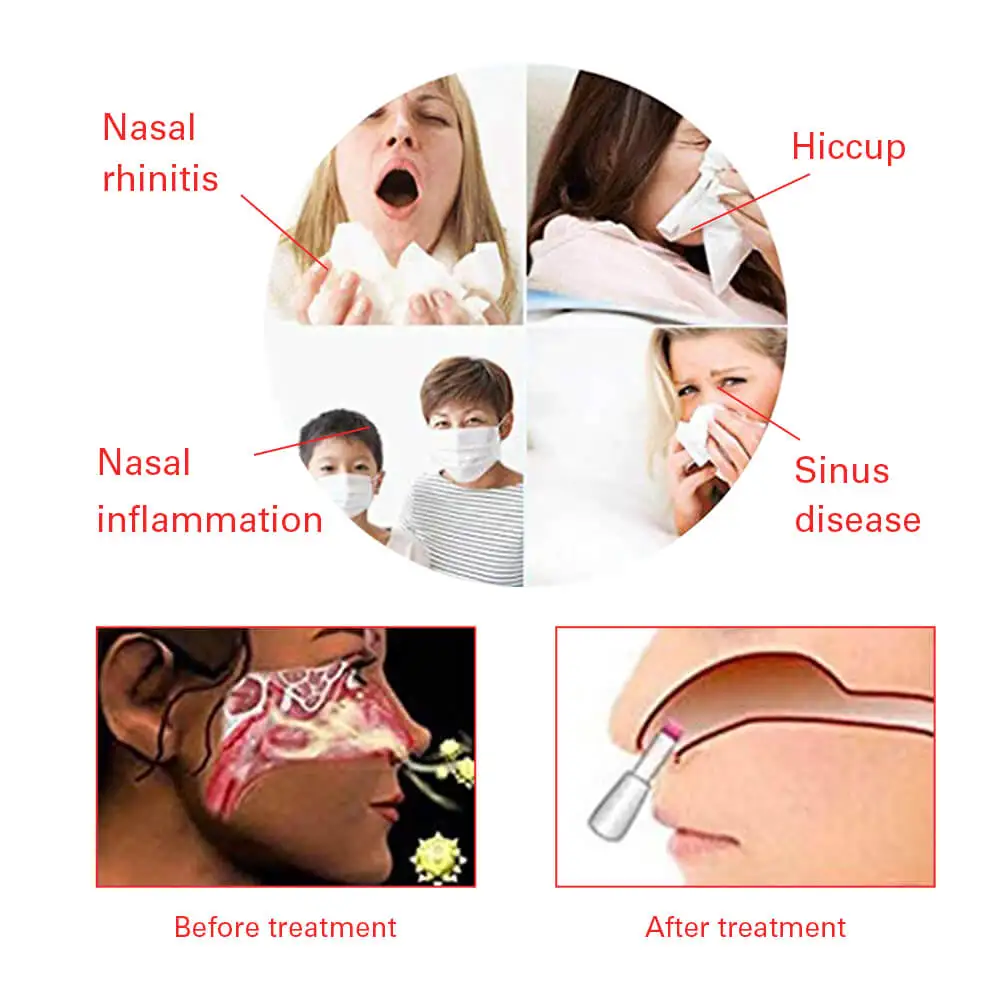 Гипоаллергенный массажер OLIECO против ринита устройство для назальной