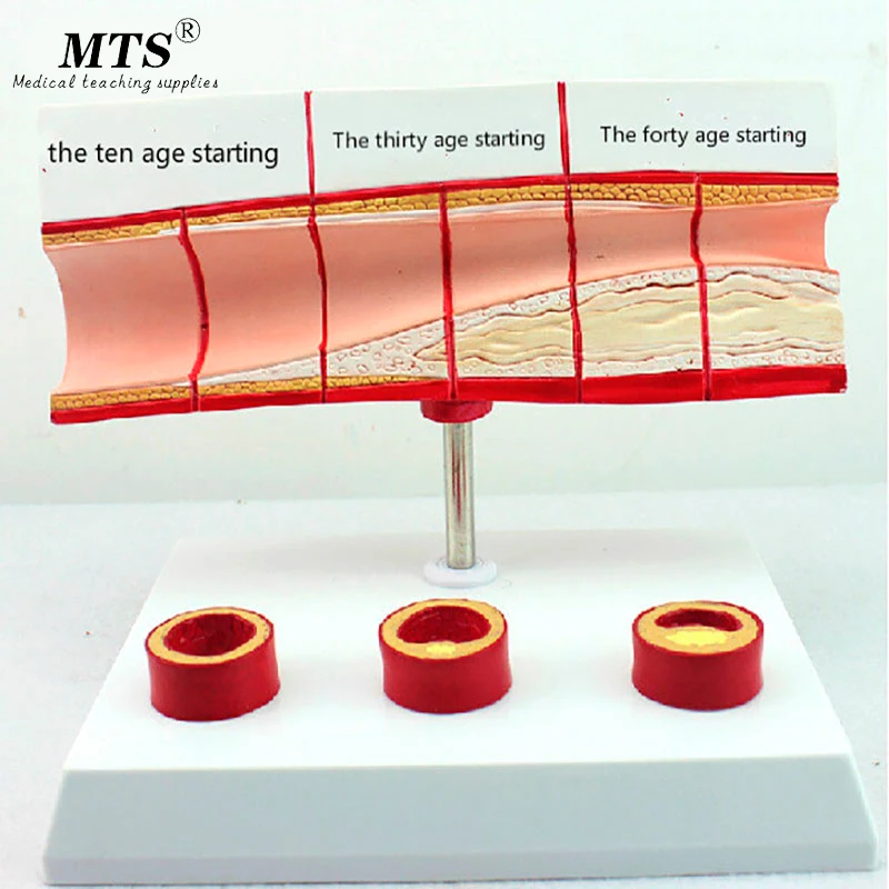 Подлинная модель кровяного холестерина и возраста EasyThru коронарная болезнь