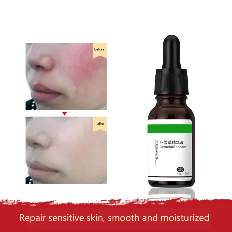 

Snow prairie fluid desalinating acne marks and repairing red blood thread hormone face shrinking pores moisturizing essence
