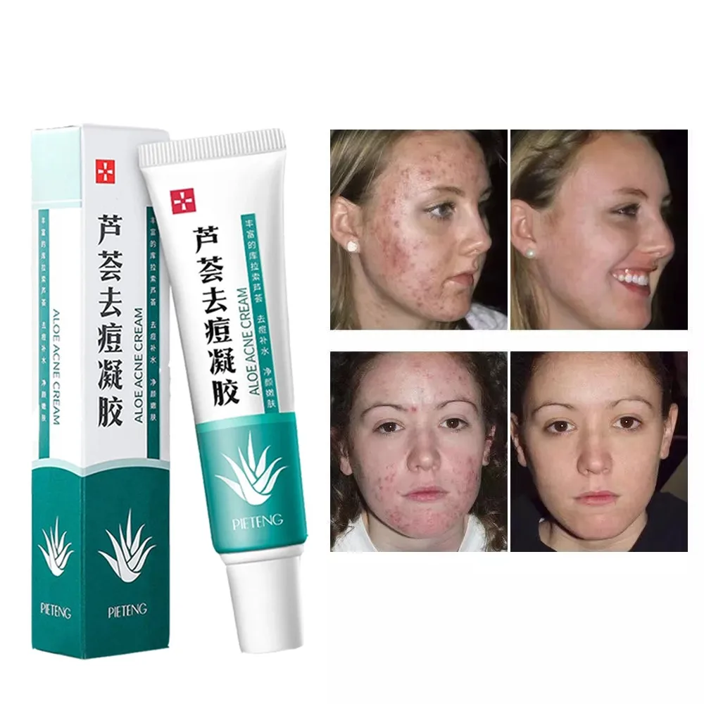 

Effective Acne Removal Cream Acne Treatment Fade Acne Spots Oil Control Shrink Pores Moisturizing Whitening Acne Cream Skin Care