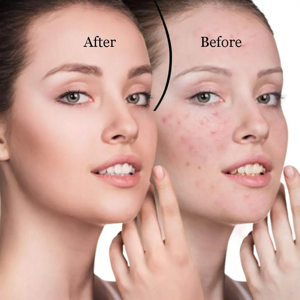 

Pore Cleaner Blackhead Remover Vacuum Face Skin Care Suction Black head Black Dots Blackheads Pimples Removal Deep Cleaning Tool