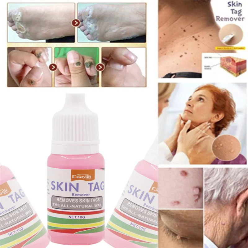 1 шт. Профессиональный средство для удаления кожных тегов 10 мл моль и согреваний