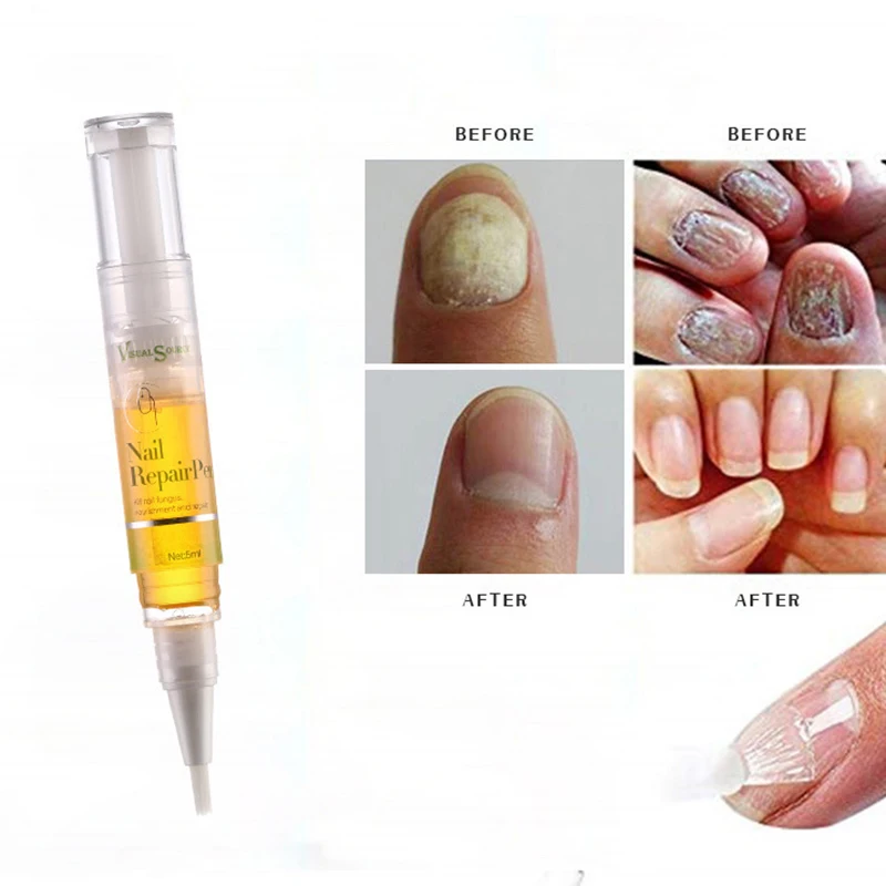 

5ml Liquid Nail Repair Pen Onychomycosis Anti Fungal Nail Nail Fungus Treatment New