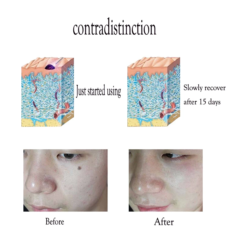 Жидкокристаллическая лазерная ручка для удаления Кротов бородавка инструмент