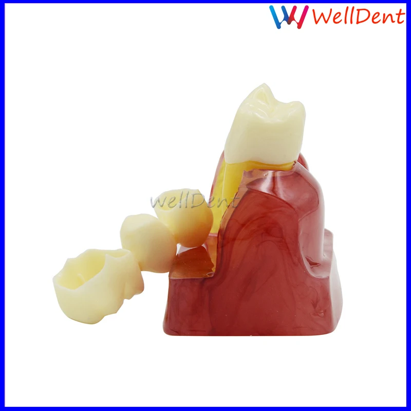 Стоматологическая зубная модель демонстрационный имплантант анализ Корона мост