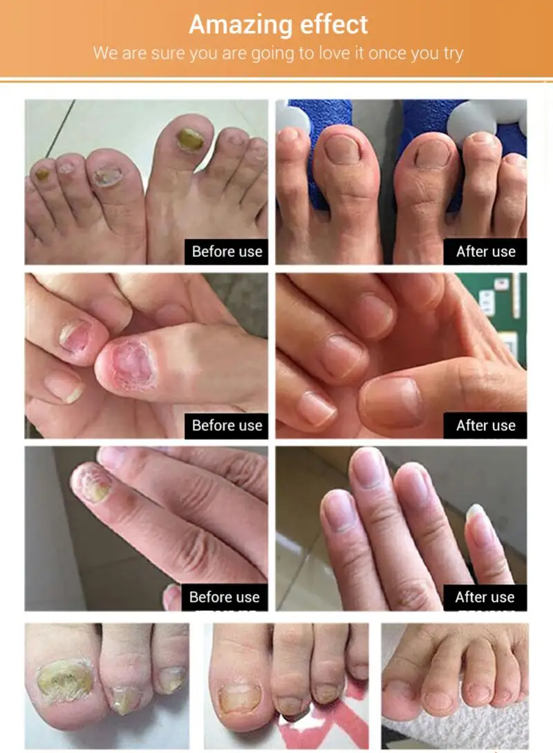 

Fungal Nail Repair Serum Care Treatment Foot Nail Fungus Removal Gel Anti Paronychia Onychomycosis TSLM1