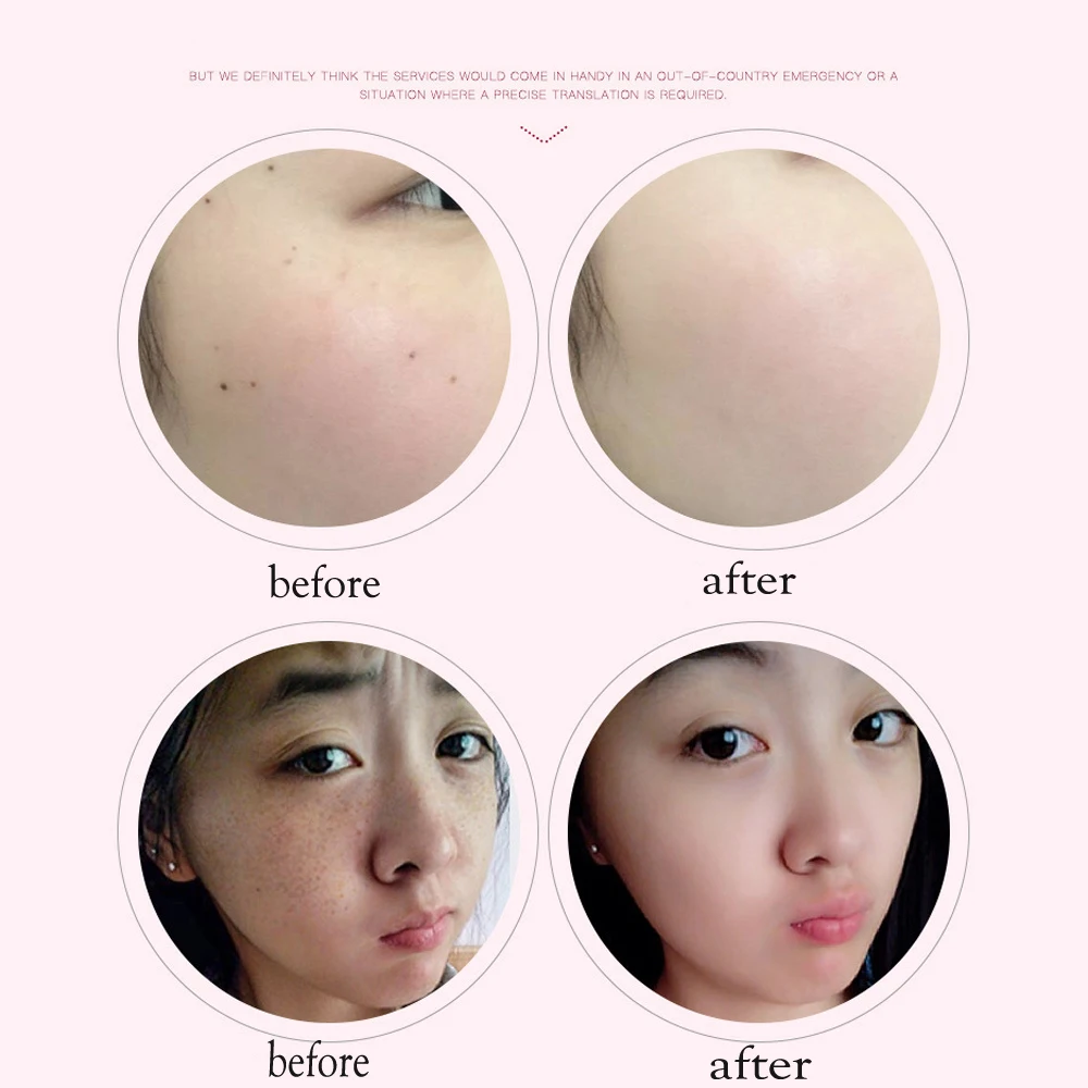 Жидкокристаллическая лазерная ручка для удаления Кротов бородавка инструмент