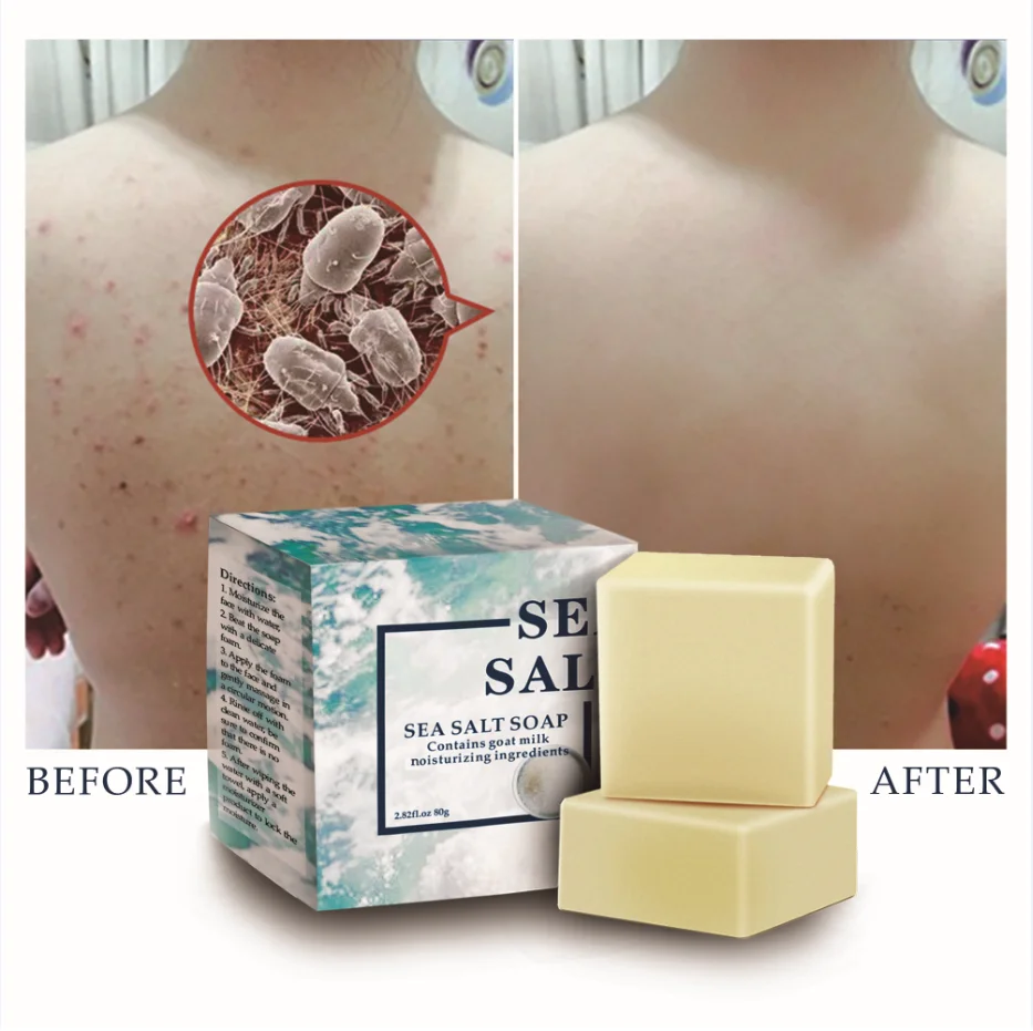 Морская соль мыло для удаления прыщей поры акне терапии морская очиститель