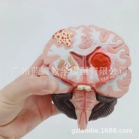 11 humans brain disease model brain anatomical model neurosurgery cerebral hemorrhage pathological medical teaching model