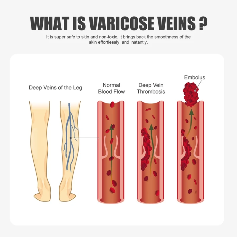 Крем для тела от варикозного расширения вен ног колен подтягивает кожу снимает