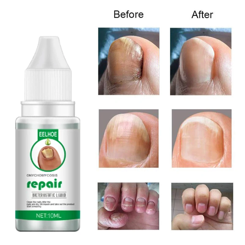 

Eelhoe Nail Fungus Treat Cuticle Oil Onychomycosi Toe Repair Serum Anti Fungal Nail Paronychia Feet Care Nails Manicure TSLM2