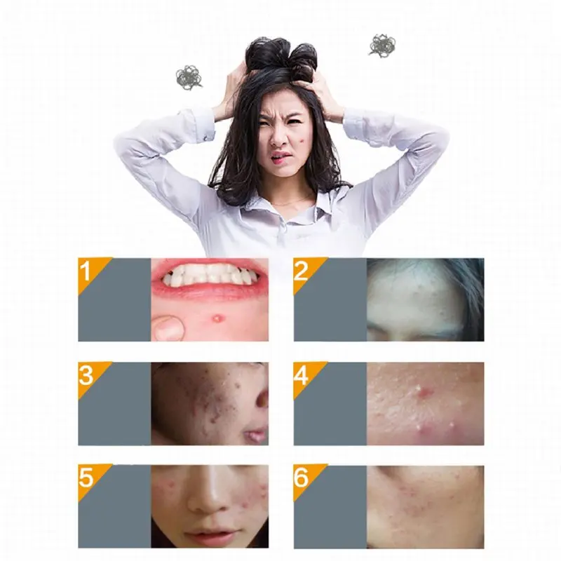 30 шт. патчи для ухода за кожей лица от веснушек и прыщей |