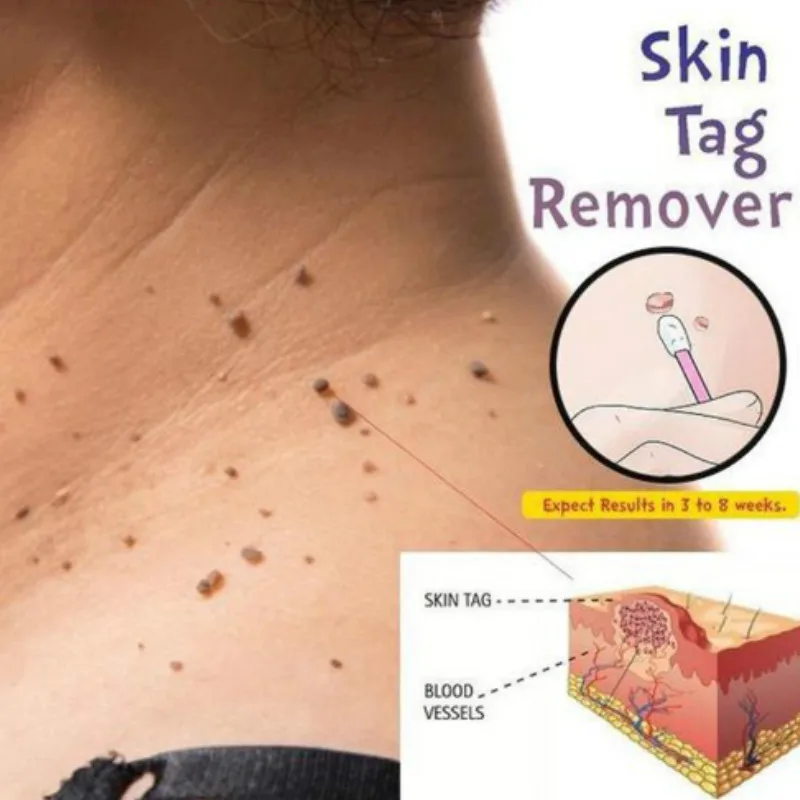 Горячая распродажа 10 мл крем для лечения бородавок средство удаления мозолей ног