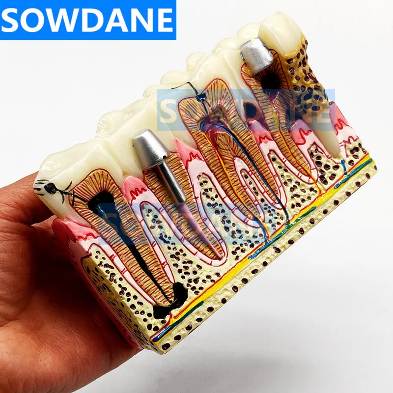 Зубные протезы модель обычной патологии обучающая зубной Стоматолог для изучения медицины