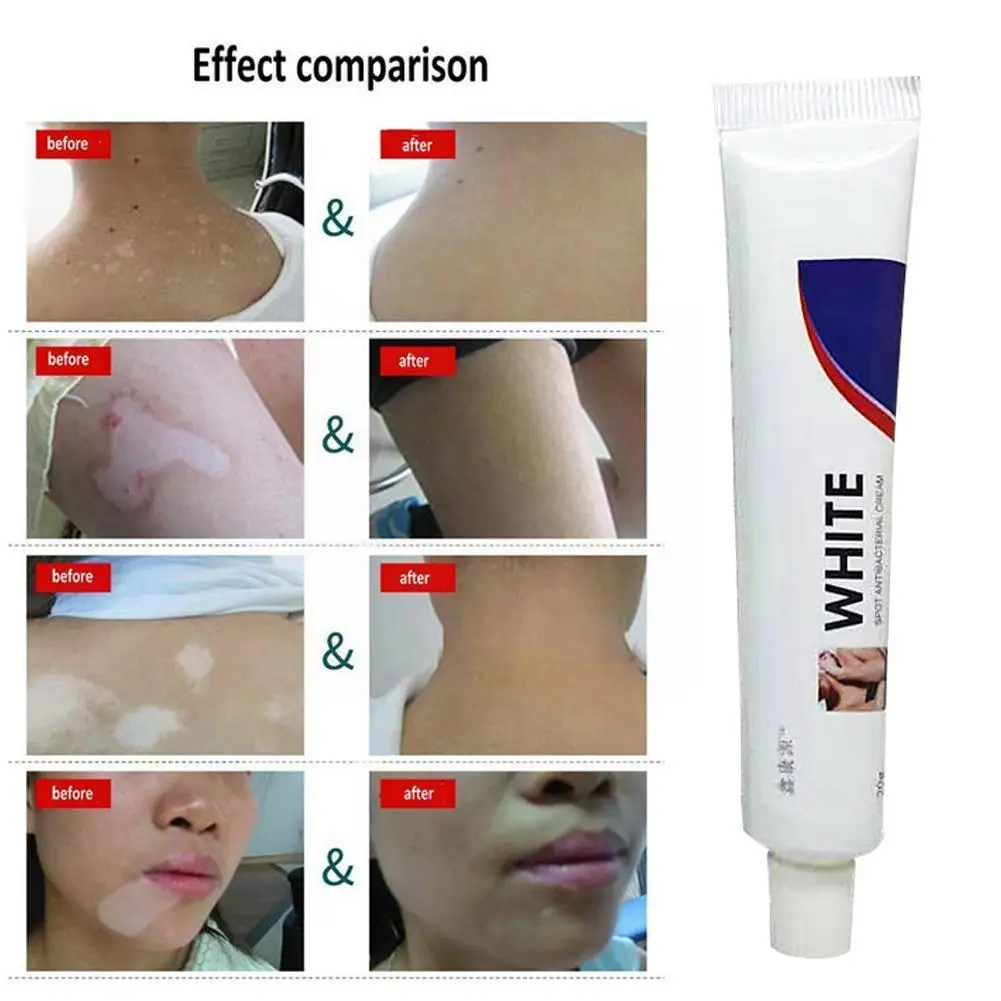 Китайский медицинский крем для лечения болезней с белыми пятнами пигмент