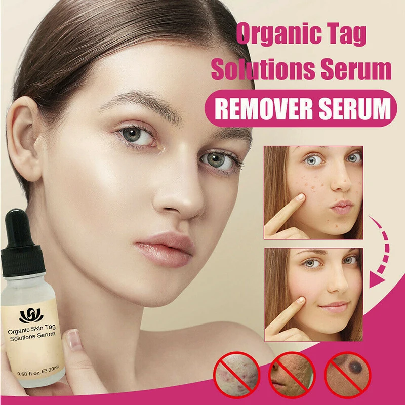 20 мл Mole & Skin Tag Repair раствор безболезненный Dark Spot Face Wart Веснушка Cream Oil TSLM1| |