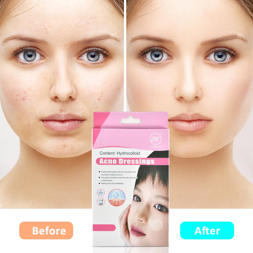 

144pcs/pack Acne Pimple Patch Invisible Acne Sticker Blemish Treatment Acne Master Pimple Remover Face Skin Care Beauty Tool