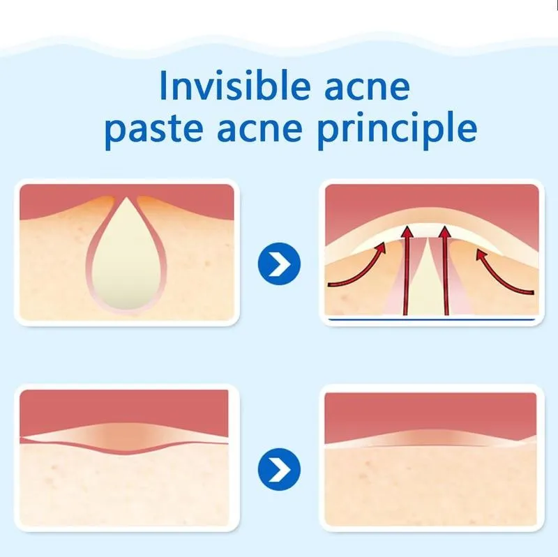

1/3sheet Invisible Acne Stickers Hydrocolloid Pimple Patch Remover Treatment Blemish Blackhead Sticker Skin Care Tool