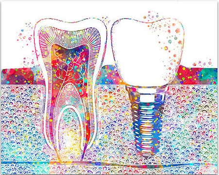 

Настенная картина Зубной имплантат Abstract