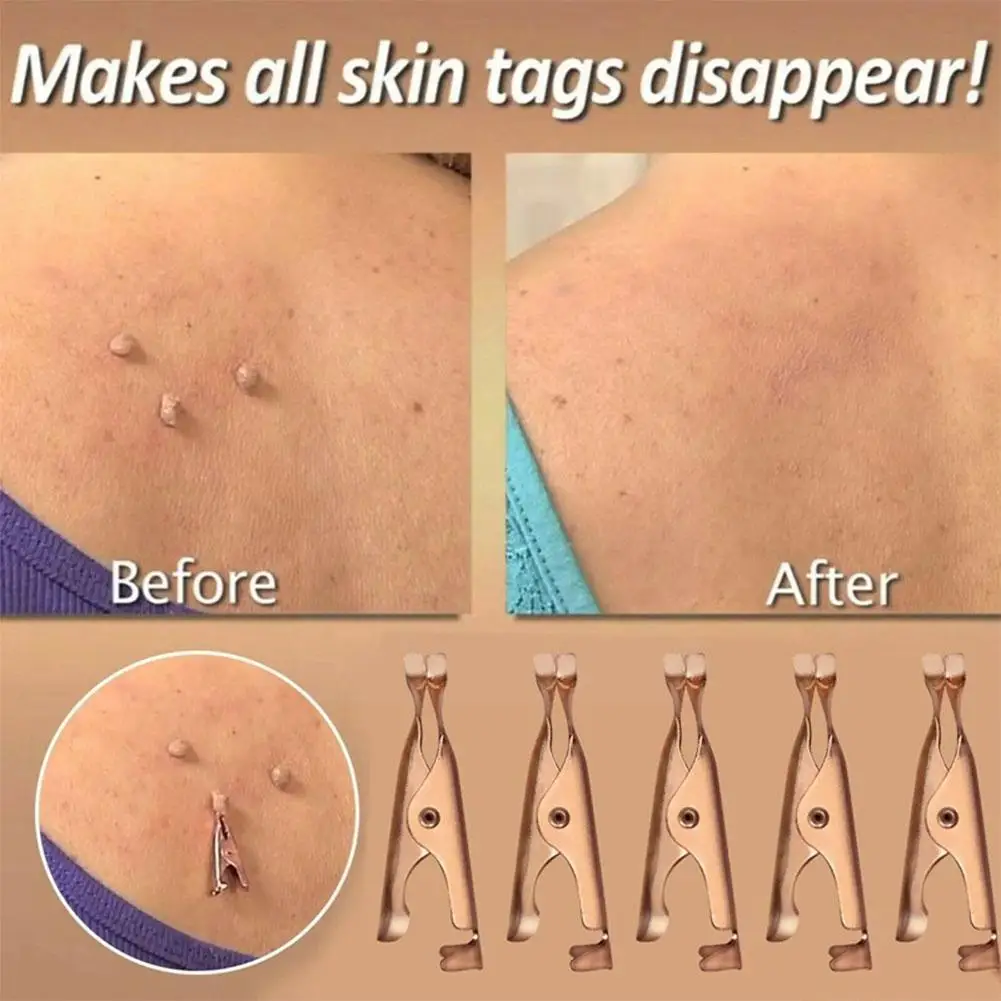 

Skin Tags Remover Clip For Wart Permanent Removal Painless Clip Tags Out Skin Wart Tags Tattoo Clamp Beauty Makeup T W5p0