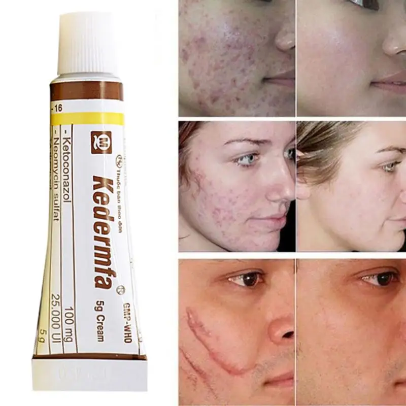 

5g Snake Ointment Skin Cream Moisturizing Hand Cream Acne Scar Remove Cream Body Face Skin Scald Burn Repair Care TSLM2