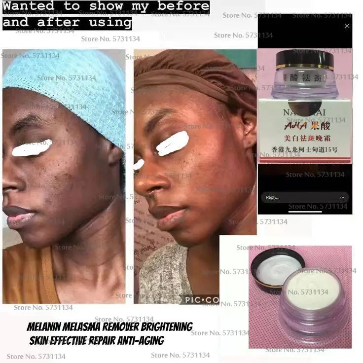

AHA Cream Serum Remove Dark Spots Skin Lightening Bleaching Body Skin Melanin Melasma Acne Treatment Scar Removal Face Care
