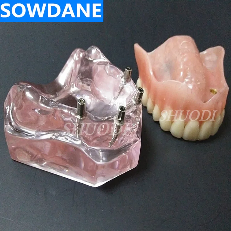 J 4 Implant Upper Стоматологическая Исследование Учебная модель стоматологического Стандартный модель съемные зубы для взрослых и детей TYPODONT модель Стоматолог Связь модель - Цвет: J 4 Implant Upper