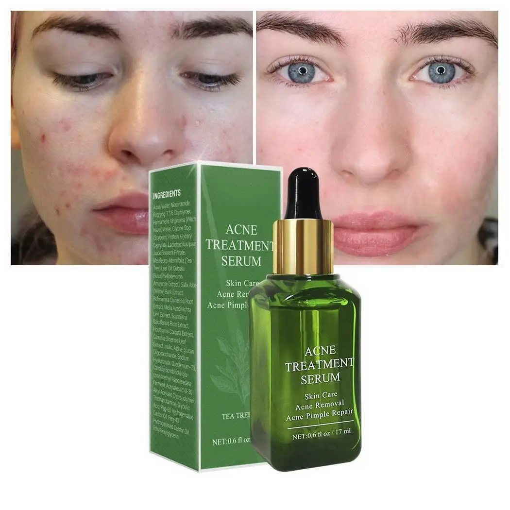 Угревая угревая головка усадка поры ремонт Сделано Китай маска для носа против