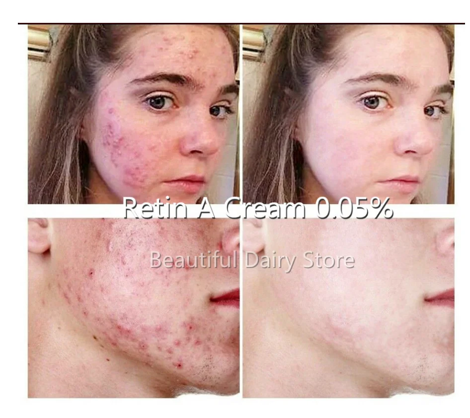 Новый крем гель Retinol с витамином A 0.05% для лечения прыщей и морщин 10 г|Дневные крема