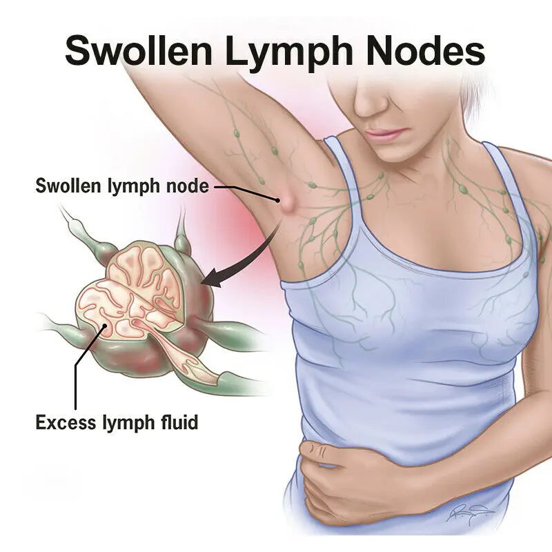 Травяной уход за лимфатией Детокс-пластырь для предотвращения лимфы пластырь
