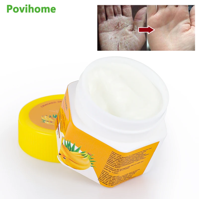 

20G Herbal Skin Cream For Skin Repair Anti-Cracking Moisturizing Ointment Treat Psoriasis Plaster Dead Skin Dermatitis Eczema