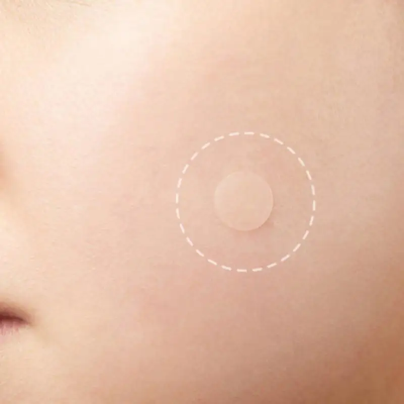 Патчи от акне натуральные поглощающие прыщи патчи медицинские Гидроколлоидные es