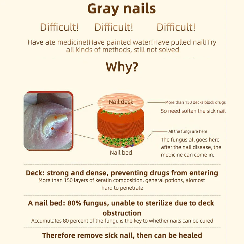Средство для удаления грибка на ногтях средство ремонта и устранения зуда |