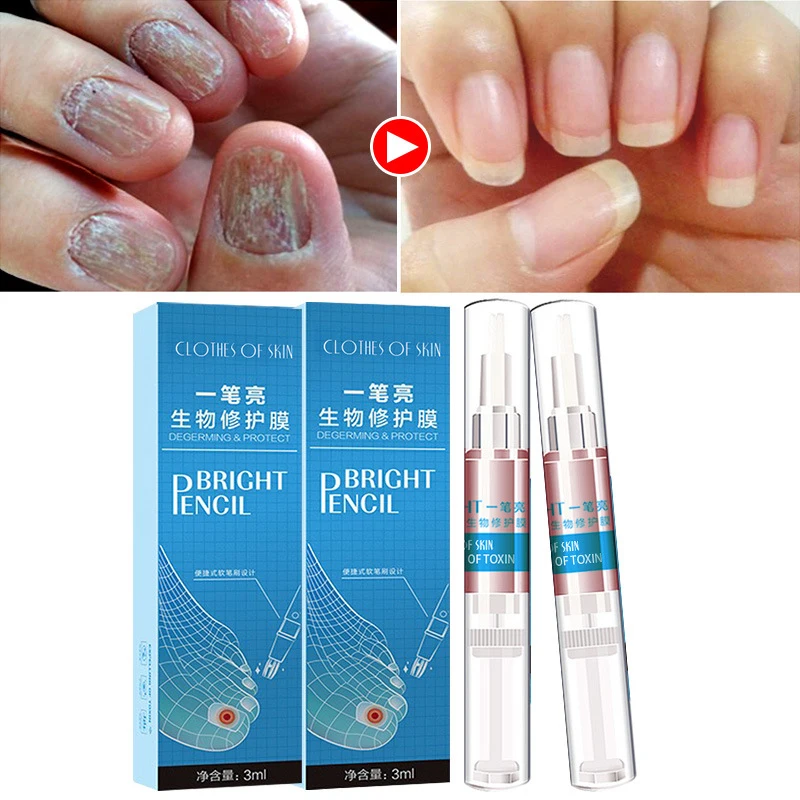 

Fungal nail treatment for penonychia, paronychia, anti-fungal nail infection, Chinese herbal medicine health care liquid