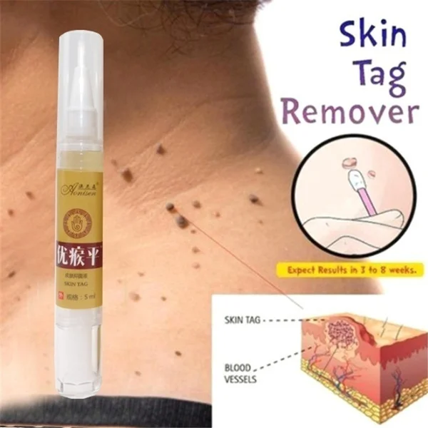 Набор для удаления бородавок на ногах антибактериостатический набор быстрого и