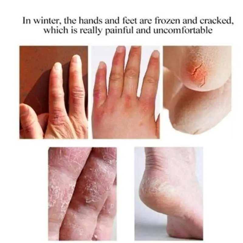 

30g Anti Dry Skin Cream Hand Foot Crack Cream Heel Chapped Peeling Hand Foot Repair Removal Dead Skin Hand Feet Care