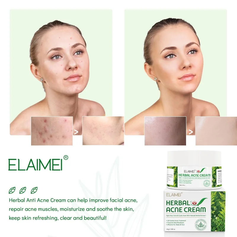 

Plant Acne Cream Mild Anti Acne Refreshing Soothing Face Acne Removal Moisturizing Skin Care 50g Y