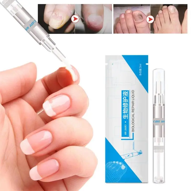 3 мл ручка для ногтей пальчиковые ногти онихомикоз пароникья инфекция флакон