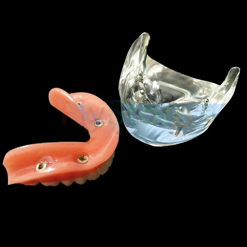 Аналогичный стоматологический имплантат внешний зубной протез