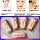 5 шт., антибактериальное мыло от акне, псориаза, экземы