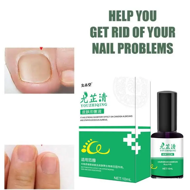 Nail Fungal Cure Nails Fungus Wart Removal Liquid Nutritious Anti Paronychia Onychomycosis Foot Repair 10ml | Красота и здоровье