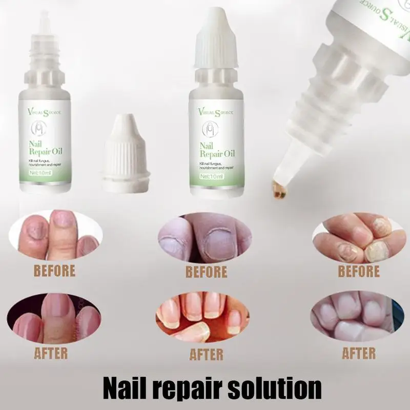 

Multiple Nail Treatment Onychomycosis Care Essence Foot Whitening Toe Fungus Removal Gel Nail Repair Liquid